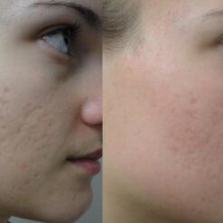 kem-tri-mun-neutrogena-on-the-spot-acne-9