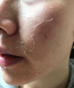 thay da sinh hoc bqcell peeling derma cream 5