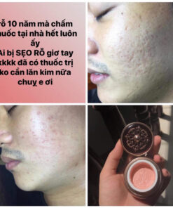 kem dong y dieu tri seo ro genie non fix skin 5